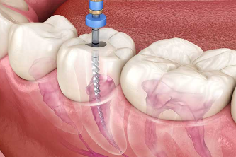 Root Canal Treatment (RCT)